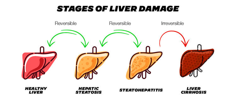 A Primer On Fatty Liver Disease | Ultrahuman